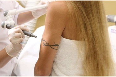 Удаление татуировок КТР лазером и о сосудистых поражениях кожи